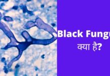 Black Fungus क्या है? पूरी जानकारी हिंदी में black fungus kya hai in hindi